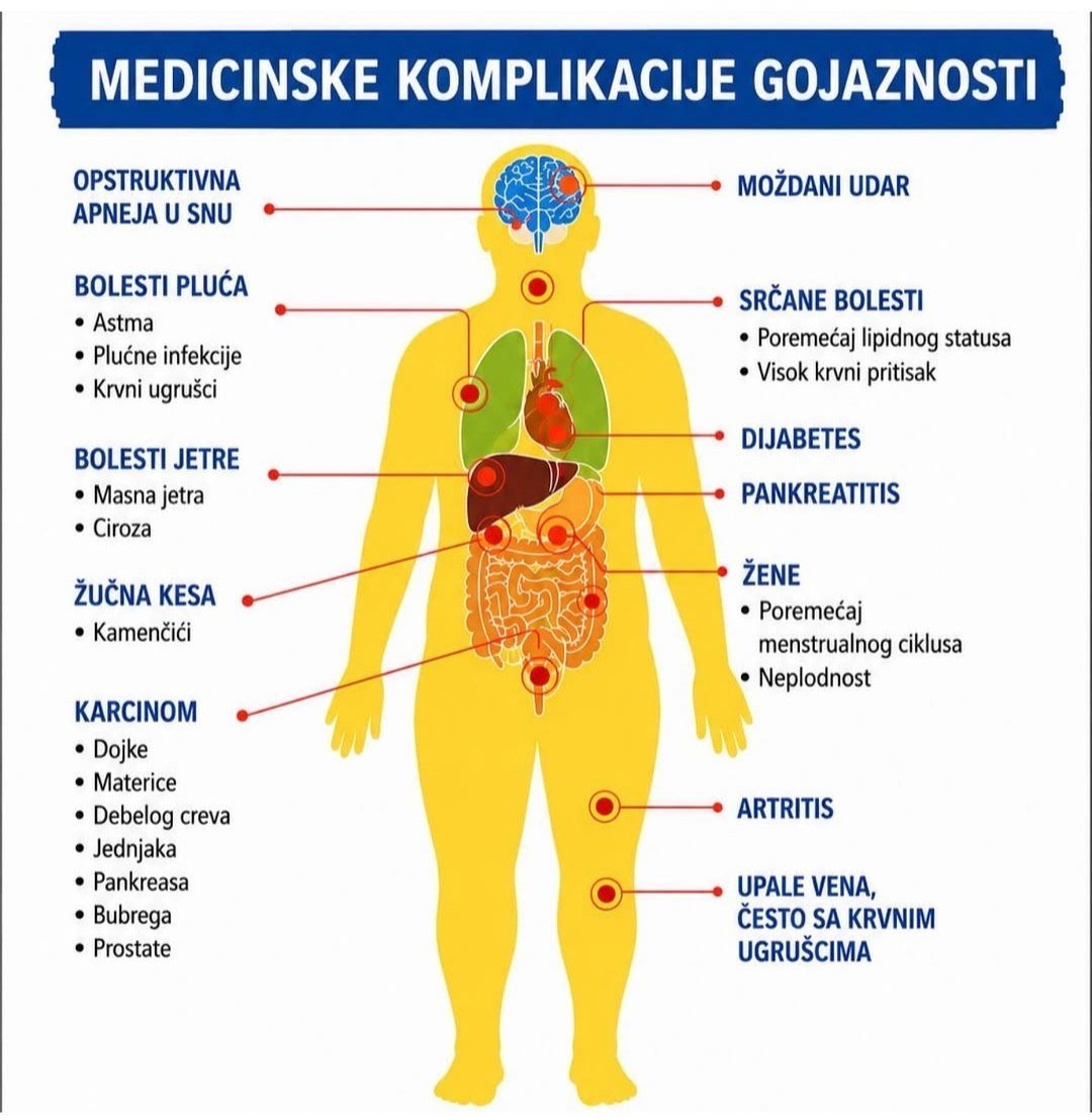Infografika medicinskih komplikacija gojaznosti: dijabetes, hipertenzija, masna jetra, apneja u snu, pankreatitis, karcinom, artritis